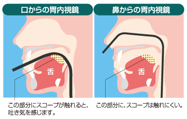 経鼻/経口内視鏡の違い