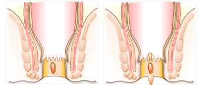 左:慢性裂肛、右:慢性裂肛（見張りイボ、肛門ポリープ）